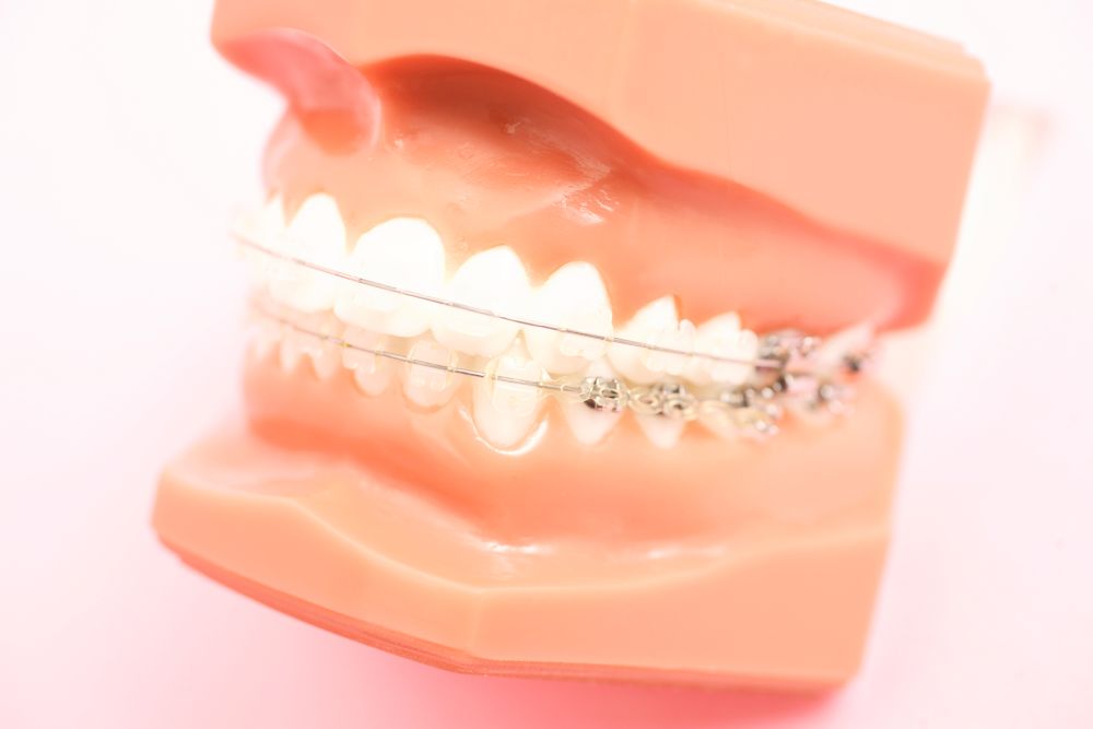 ブラケット矯正（ワイヤー矯正）