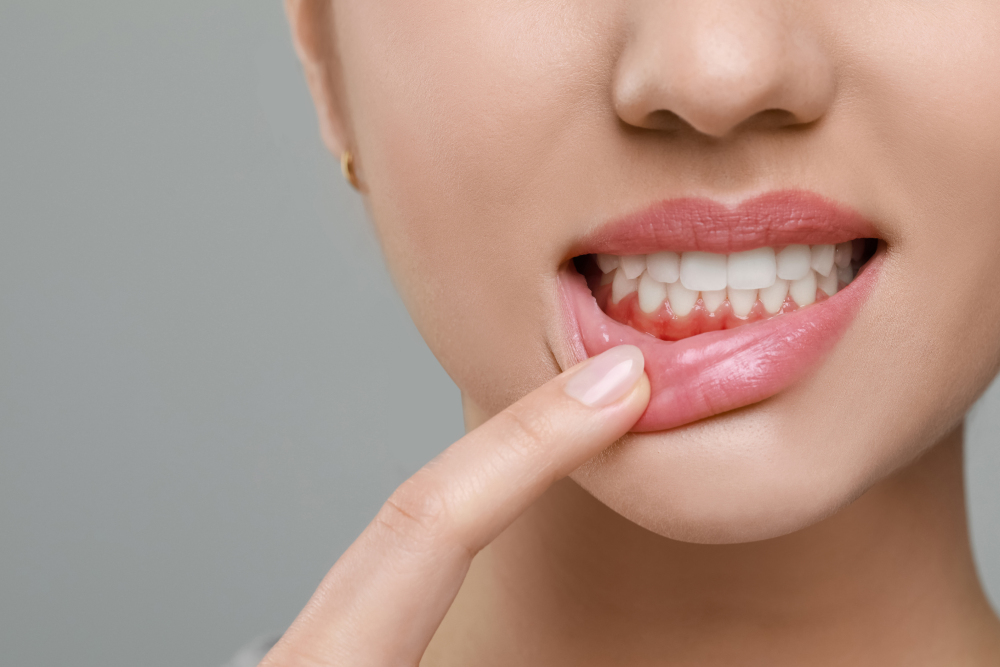 ガムピーリング
