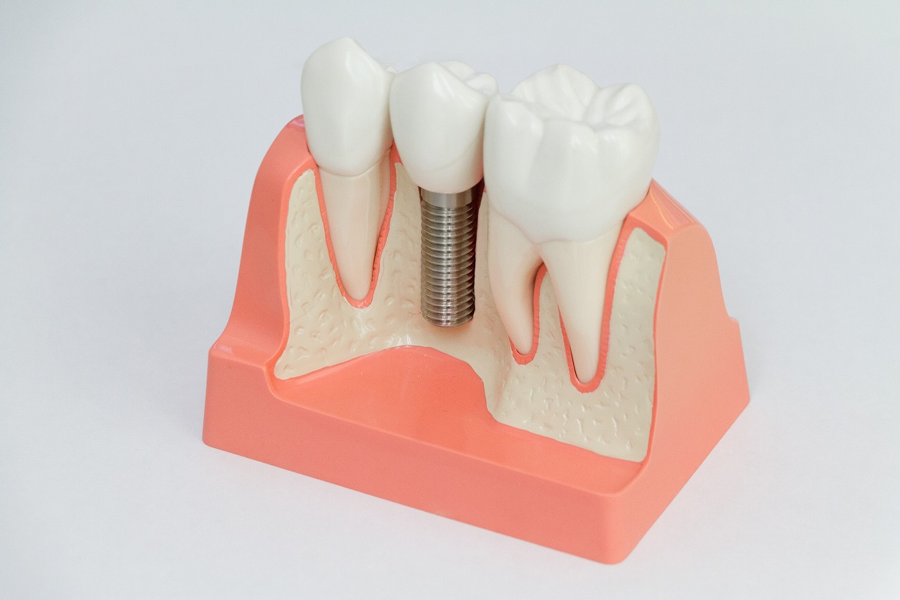 インプラント治療とは