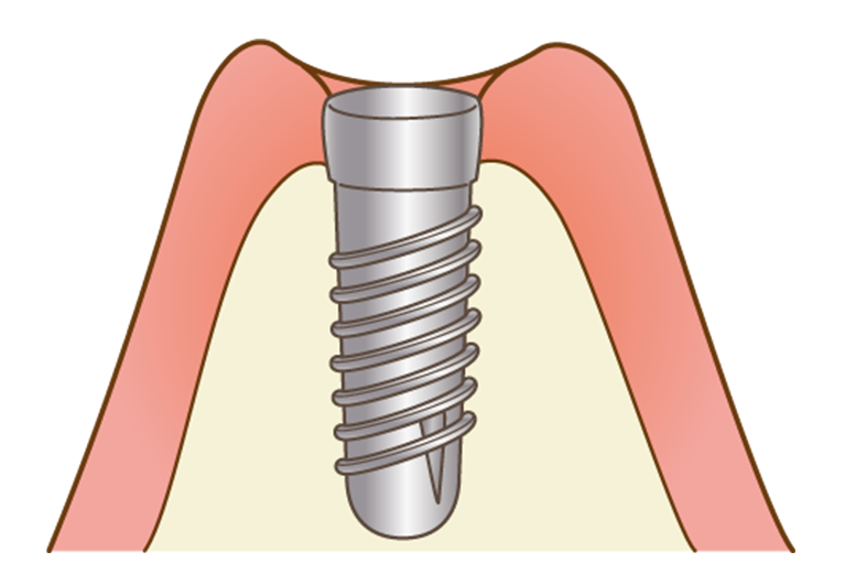 インプラント埋入手術（１次オペ）
