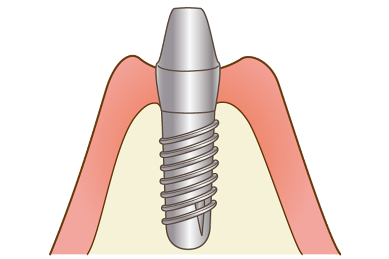 インプラント埋入手術（２次オペ）