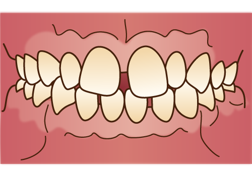 空隙歯列