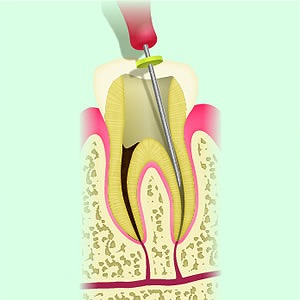 ファイルで感染した神経をかき出し綺麗にする