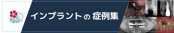インプラント症例集